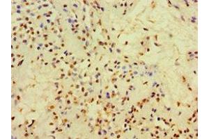 Immunohistochemistry of paraffin-embedded human breast cancer using ABIN7148384 at dilution of 1:100 (Adipsin antibody  (AA 26-253))