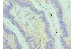Immunohistochemistry of paraffin-embedded human colon cancer using ABIN7160711 at dilution of 1:100 (ASMTL antibody  (AA 1-290))