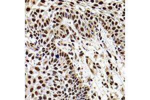 Immunohistochemistry of paraffin-embedded human well-differentiated squamous skin carcinoma using HIRIP3 antibody (ABIN6128019, ABIN6141779, ABIN6141780 and ABIN6222788) at dilution of 1:100 (40x lens).