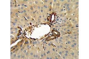 Annexin V antibody IHC analysis in formalin fixed and paraffin embedded human hepatocarcinoma. (Annexin V antibody  (AA 262-291))
