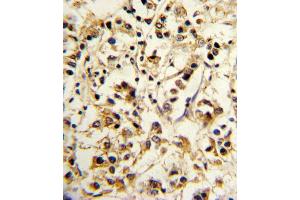 Formalin-fixed and paraffin-embedded human breast carcinoma reacted with KIR2DL4 Antibody (C-term), which was peroxidase-conjugated to the secondary antibody, followed by DAB staining. (KIR2DL4/CD158d antibody  (C-Term))