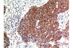 Immunohistochemical analysis of paraffin-embedded Human Breast Carcinoma Tissue using Beclin-1 Mouse mAb diluted at 1:200. (Beclin 1 antibody)