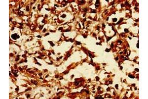 Immunohistochemistry of paraffin-embedded human melanoma using ABIN7147471 at dilution of 1:100 (LASS5 antibody  (AA 332-392))