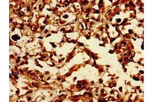 Immunohistochemistry of paraffin-embedded human melanoma using ABIN7147471 at dilution of 1:100