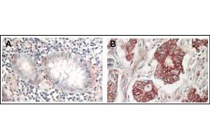 AP22624PU-N AKT antibody staining of Formalin-Fixed Paraffin-Embedded Sections at 1/1,000 dilution: Panel A: Normal colon tissue Panel B: Tumor tissue. (AKT1 antibody  (C-Term))