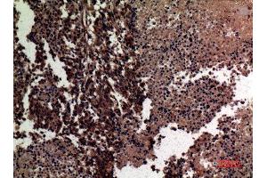Immunohistochemistry (IHC) analysis of paraffin-embedded Human Lung Cancer, antibody was diluted at 1:100. (MMP12 antibody  (Internal Region))
