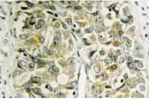 Immunohistochemistry (IHC) analyzes of Galectin-8 antibody in paraffin-embedded human prostate carcinoma tissue. (LGALS8 antibody)