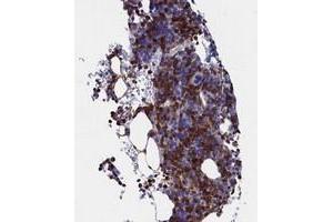 Immunohistochemical staining of human bone marrow with TYROBP polyclonal antibody  shows strong cytoplasmic positivity in hematopoietic cells.