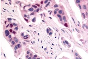 Anti-CDK12 / CRKRS antibody  ABIN1048422 IHC staining of human breast carcinoma. (CDK12 antibody  (Internal Region))