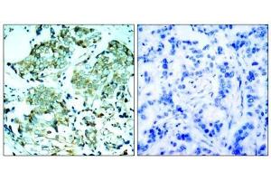 Immunohistochemical analysis of paraffin-embedded human breast carcinoma tissue, using (EGFR antibody)