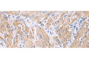 Immunohistochemistry of paraffin-embedded Human gastric cancer tissue using FBXO45 Polyclonal Antibody at dilution of 1:40(x200) (FBXO45 antibody)