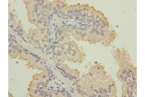 Immunohistochemistry of paraffin-embedded human prostate cancer using ABIN7157360 at dilution of 1:100 (Keratin 33B antibody  (AA 1-404))