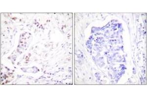 Immunohistochemistry analysis of paraffin-embedded human breast carcinoma tissue, using Cyclin A1 Antibody. (Cyclin A1 antibody  (AA 411-460))