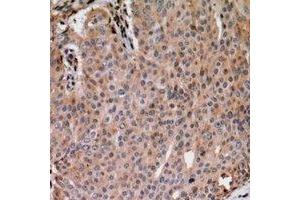 Immunohistochemical analysis of ANAPC1 (pS688) staining in human breast cancer formalin fixed paraffin embedded tissue section. (APC1 antibody  (pSer688))