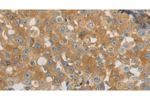 Immunohistochemistry of paraffin-embedded Human breast cancer using PLPP1 Polyclonal Antibody at dilution of 1:40 (PLPP1 antibody)