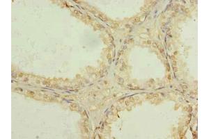 Immunohistochemistry of paraffin-embedded human prostate cancer using ABIN7174340 at dilution of 1:100 (USP47 antibody  (AA 1-157))