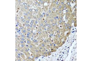 Immunohistochemistry of paraffin-embedded human colon carcinoma using PPOX antibody at dilution of 1:100 (x40 lens).