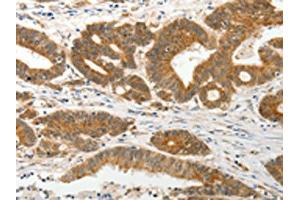 The image on the left is immunohistochemistry of paraffin-embedded Human colon cancer tissue using ABIN7131078(SLC12A1 Antibody) at dilution 1/15, on the right is treated with fusion protein. (SLC12A1 antibody)