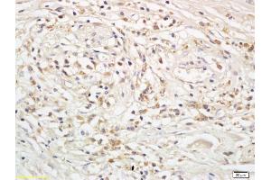 Formalin-fixed and paraffin embedded human rectal cancer labeled with Anti-Snail/SNAI 1 Polyclonal Antibody, Unconjugated (ABIN685597) followed by conjugation to the secondary antibody and DAB staining (SNAI1, SNAI2, SNAI3 (AA 188-264) antibody)