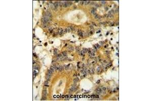 RPS6KA1 Antibody (ABIN654115 and ABIN2843994) immunohistochemistry analysis in formalin fixed and paraffin embedded human colon carcinoma followed by peroxidase conjugation of the secondary antibody and DAB staining. (RPS6KA1 antibody)