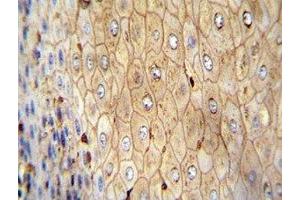 Beta-Actin antibody immunohistochemistry analysis in formalin fixed and paraffin embedded human esophageal carcinoma. (beta Actin antibody)