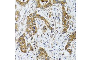 Immunohistochemistry of paraffin-embedded human colon carcinoma using BLZF1 antibody (ABIN2561429) at dilution of 1:100 (40x lens). (BLZF1 antibody)