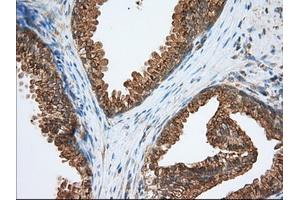 Immunohistochemical staining of paraffin-embedded Adenocarcinoma of Human ovary tissue using anti-PDE4A mouse monoclonal antibody. (PDE4A antibody)
