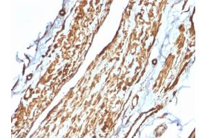 Formalin-fixed, paraffin-embedded human Testicular Carcinoma stained with VCL Mouse Monoclonal Antibody (VCL/2575). (Vinculin antibody  (AA 174-322))