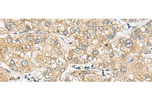 Immunohistochemistry of paraffin-embedded Human liver cancer tissue using DACT3 Polyclonal Antibody at dilution of 1:70(x200) (DACT3 antibody)