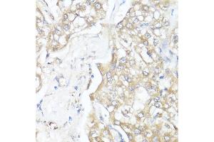 Immunohistochemistry of paraffin-embedded human liver cancer using Smad7 antibody (ABIN7270356) at dilution of 1:100 (40x lens). (SMAD7 antibody  (AA 1-100))