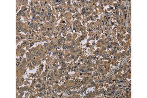Immunohistochemistry of Human liver cancer using CAB39 Polyclonal Antibody at dilution of 1:40 (CAB39 antibody)