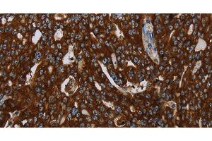 Immunohistochemistry of paraffin-embedded Human ovarian cancer tissue using KISS1R Polyclonal Antibody at dilution 1:30 (KISS1R antibody)