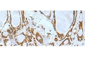 Immunohistochemistry of paraffin-embedded Human thyroid cancer tissue using TSGA10 Polyclonal Antibody at dilution of 1:50(x200) (TSGA10 antibody)