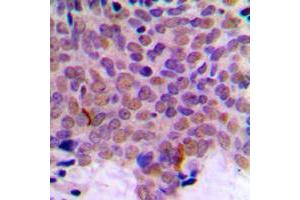 Immunohistochemical analysis of CLK1 staining in human breast cancer formalin fixed paraffin embedded tissue section. (CLK1 antibody  (Center))