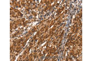 Immunohistochemistry of Human thyroid cancer using CYP2D6 Polyclonal Antibody at dilution of 1:40 (CYP2D6 antibody)