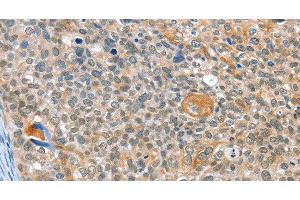 Immunohistochemistry of paraffin-embedded Human cervical cancer using ALDOB Polyclonal Antibody at dilution of 1:40 (ALDOB antibody)