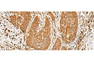Immunohistochemistry of paraffin-embedded Human esophagus cancer tissue using PPOX Polyclonal Antibody at dilution of 1:30(x200) (PPOX antibody)