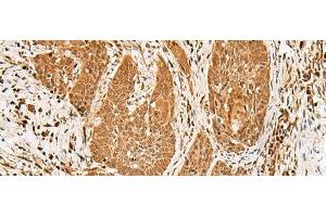 Immunohistochemistry of paraffin-embedded Human esophagus cancer tissue using PPOX Polyclonal Antibody at dilution of 1:30(x200)