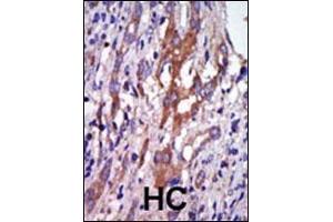 Formalin-fixed and paraffin-embedded human cancer tissue reacted with the primary antibody, which was peroxidase-conjugated to the secondary antibody, followed by DAB staining. (Aurora A antibody  (N-Term))