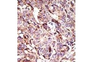 Formalin-fixed and paraffin-embedded human cancer tissue reacted with the primary antibody, which was peroxidase-conjugated to the secondary antibody, followed by AEC staining. (ARL6 antibody  (N-Term))