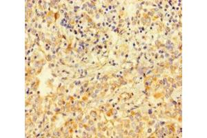 Immunohistochemistry of paraffin-embedded human lung cancer using ABIN7175511 at dilution of 1:100 (Vimentin antibody  (AA 2-466))