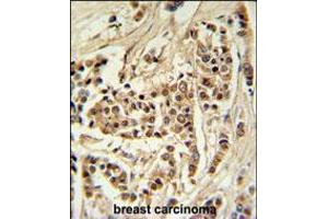 TTPAL Antibody IHC analysis in formalin fixed and paraffin embedded human breast carcinoma followed by peroxidase conjugation of the secondary antibody and DAB staining. (TTPAL antibody  (C-Term))