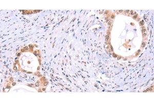 Immunohistochemistry of paraffin-embedded Human cervical cancer tissue using PROS1 Polyclonal Antibody at dilution 1:60