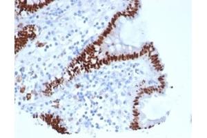 Formalin-fixed, paraffin-embedded human colon carcinoma stained with CDX2 Recombinant Mouse Monoclonal Antibody (rCDX2/6921). (Recombinant CDX2 antibody)