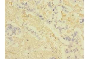 Immunohistochemistry of paraffin-embedded human pancreatic cancer using ABIN7147896 at dilution of 1:100 (Claudin 18 antibody  (AA 20-80))