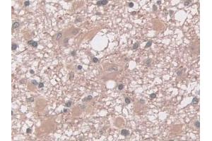 DAB staining on IHC-P; Samples: Human Glioma Tissue (Interferon gamma antibody  (AA 24-166))