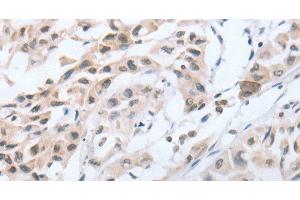 Immunohistochemistry of paraffin-embedded Human lung cancer tissue using CHRNA10 Polyclonal Antibody at dilution 1:50 (CHRNA10 antibody)