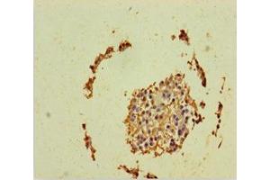 Immunohistochemistry of paraffin-embedded human breast cancer using ABIN7150314 at dilution of 1:100 (GINS2 antibody  (AA 1-185))