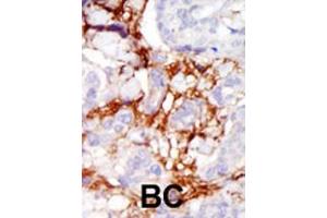 Formalin-fixed and paraffin-embedded human cancer tissue reacted with the primary antibody, which was peroxidase-conjugated to the secondary antibody, followed by AEC staining. (PAK3 antibody  (AA 218-247))