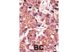 Formalin-fixed and paraffin-embedded human cancer tissue reacted with the primary antibody, which was peroxidase-conjugated to the secondary antibody, followed by AEC staining. (CDC25A antibody  (pSer278))
